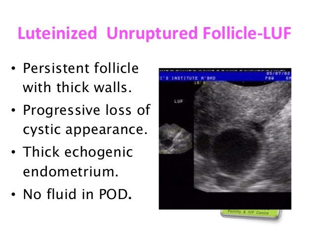 luteinized unruptured follicle syndrome