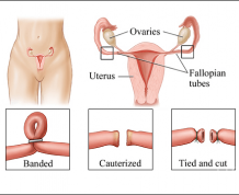 tubal ligation reversal