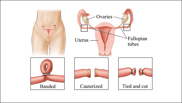 tubal ligation reversal