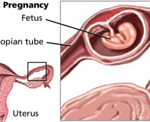 Ectopic (Tubal) Pregnancy Causes, Symptoms and Treatments