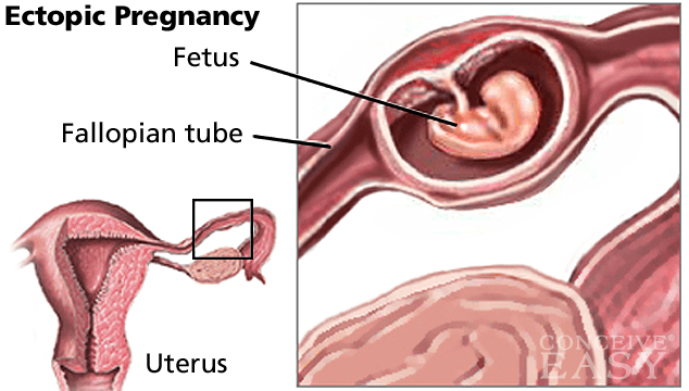 Ectopic (Tubal) Pregnancy Causes, Symptoms and Treatments