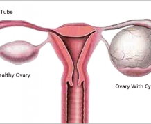 Ovarian Cysts: Symptoms, Causes and Treatments