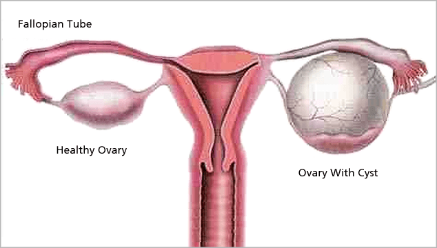 Ovarian Cysts: Symptoms, Causes and Treatments