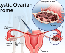 PCOS (Polycystic Ovarian Syndrome) and Infertility