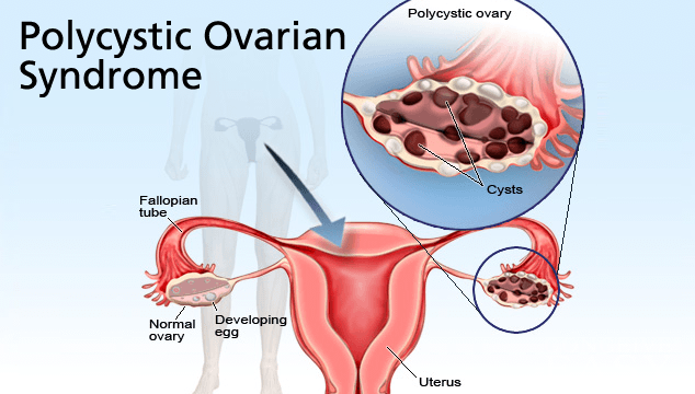 Polycystic Ovarian Syndrome and its negative effects to fertility