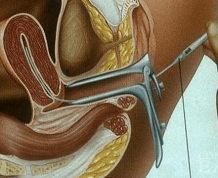 Intrauterine Insemination or Artificial Insemination