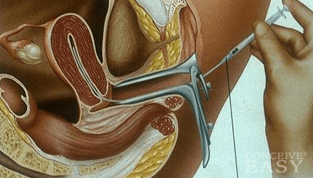 Intrauterine Insemination or Artificial Insemination