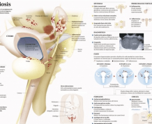 Fertility and Endometriosis