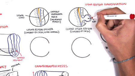 neural tube defects