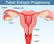 Treatment for Ectopic Pregnancy