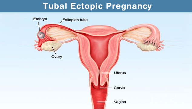 Treatment for Ectopic Pregnancy