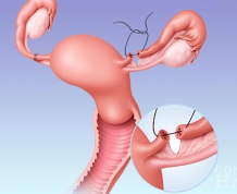 Getting Pregnant After Tubal Ligation