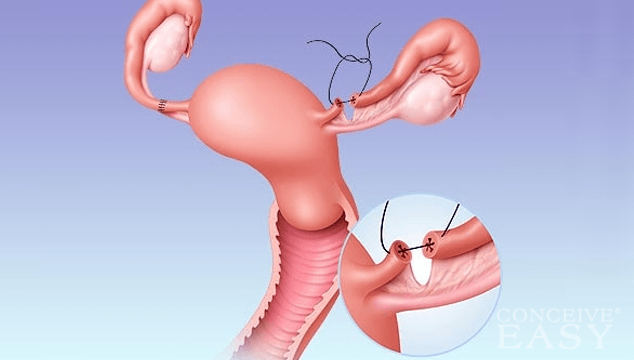 Getting Pregnant After Tubal Ligation