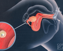 What is Intrauterine Insemination (IUI)?