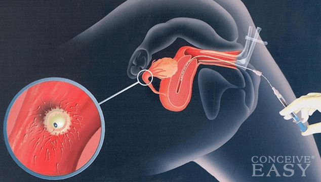 What is Intrauterine Insemination (IUI)?