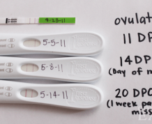 What is Molar Pregnancy (Hydatidiform Mole)?