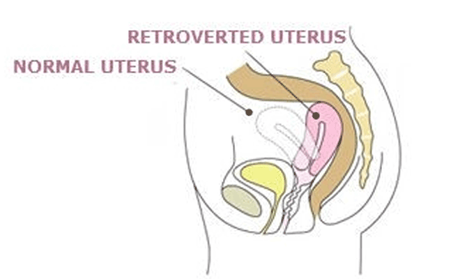 Retroverted VS normal uterus