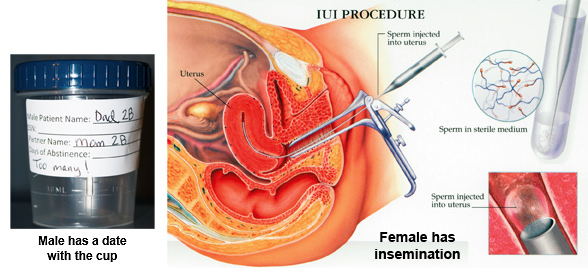 intrauterine insemination is used when the man has low sperm count