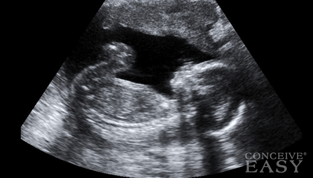 First and Second Trimester Miscarriage Symptoms