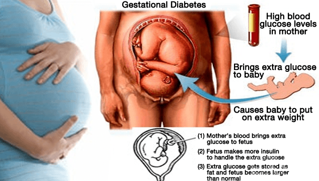 Reduce Risk Of Gestational Diabetes