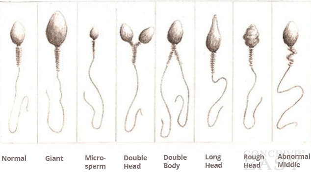 Abnormal Sperm Morphology and Male Infertility