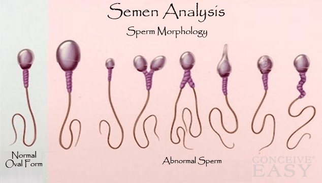Treatment Options for Low Sperm Motility