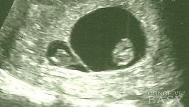 Complications of Vanishing Twin Syndrome