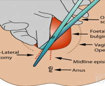 Which Is Better: Episiotomy or Tearing?