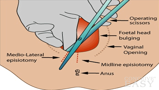 Which Is Better: Episiotomy or Tearing?