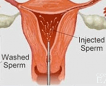 When Should You Have IUI After Getting hCG Shot?