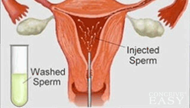 When Should You Have IUI After Getting hCG Shot?