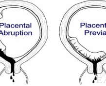 What Is Placenta Previa?