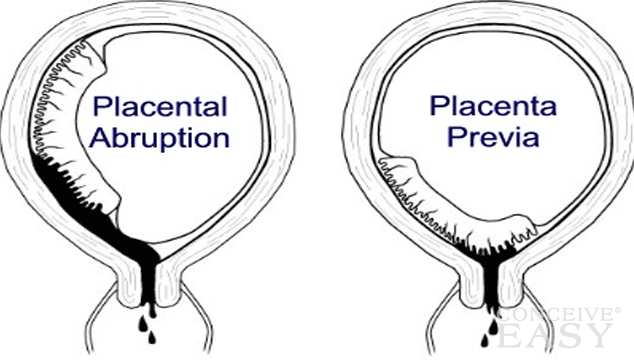 What Is Placenta Previa?