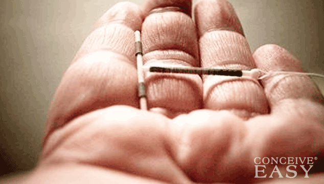 How Long to Get Pregnant After IUD Removal?
