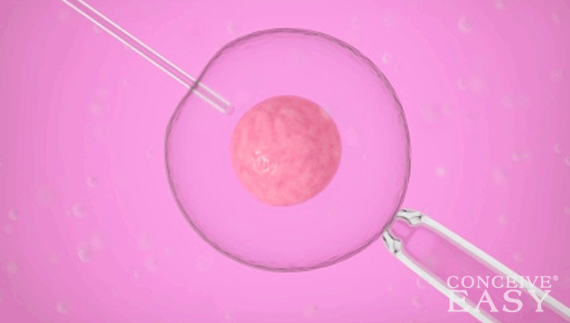 Does IVF after Tubal Ligation Work?