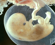Can an Abortion Cause Infertility?