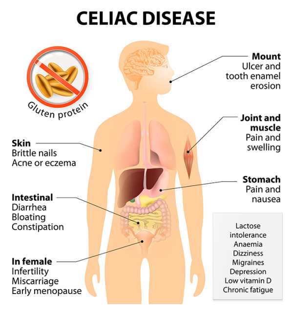 gluten free for fertility - celiac disease