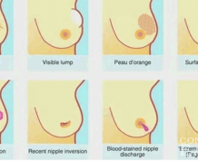 Do Fertility Treatments Cause Breast Cancer?