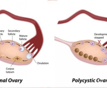 How Do I Know if I Have PCOS?