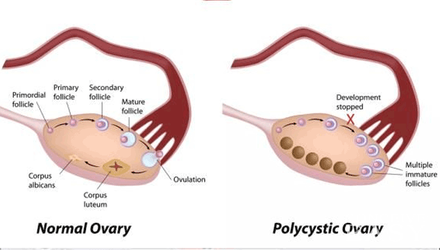 How Do I Know if I Have PCOS?