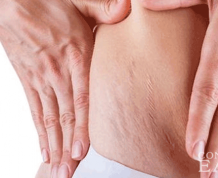 What is the Best Cream for Stretch Marks?