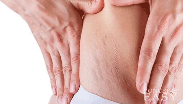 What is the Best Cream for Stretch Marks?