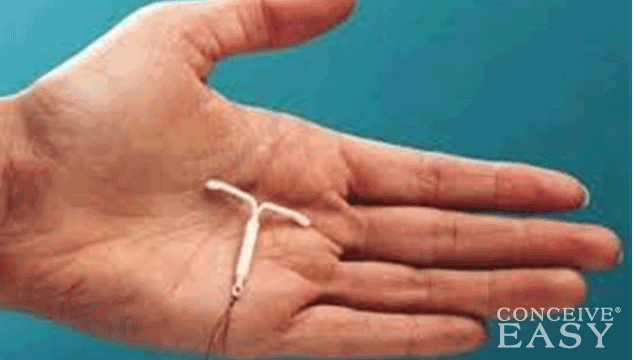 More U.S. Women Choosing IUDs for Birth Control