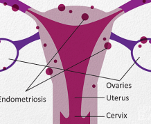 What Does It Mean To Have Endometriosis?