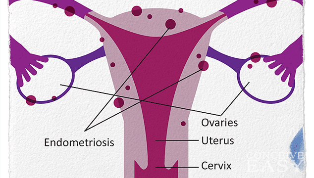 What Does It Mean To Have Endometriosis?