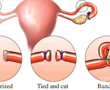 Can I Get Pregnant After Tubal Ligation?