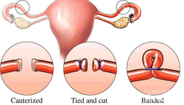 Can I Get Pregnant After Tubal Ligation?