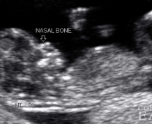 Down's Syndrome Screening: NHS Could Soon Offer Far More Reliable Test for Pregnant Women