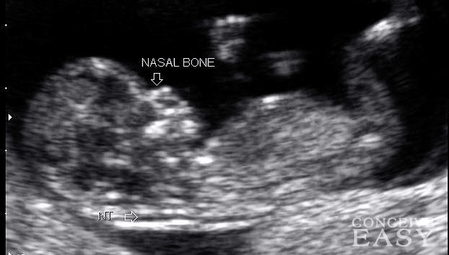 Down's Syndrome Screening: NHS Could Soon Offer Far More Reliable Test for Pregnant Women