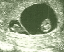 What is Vanishing Twin Syndrome (VTS)?